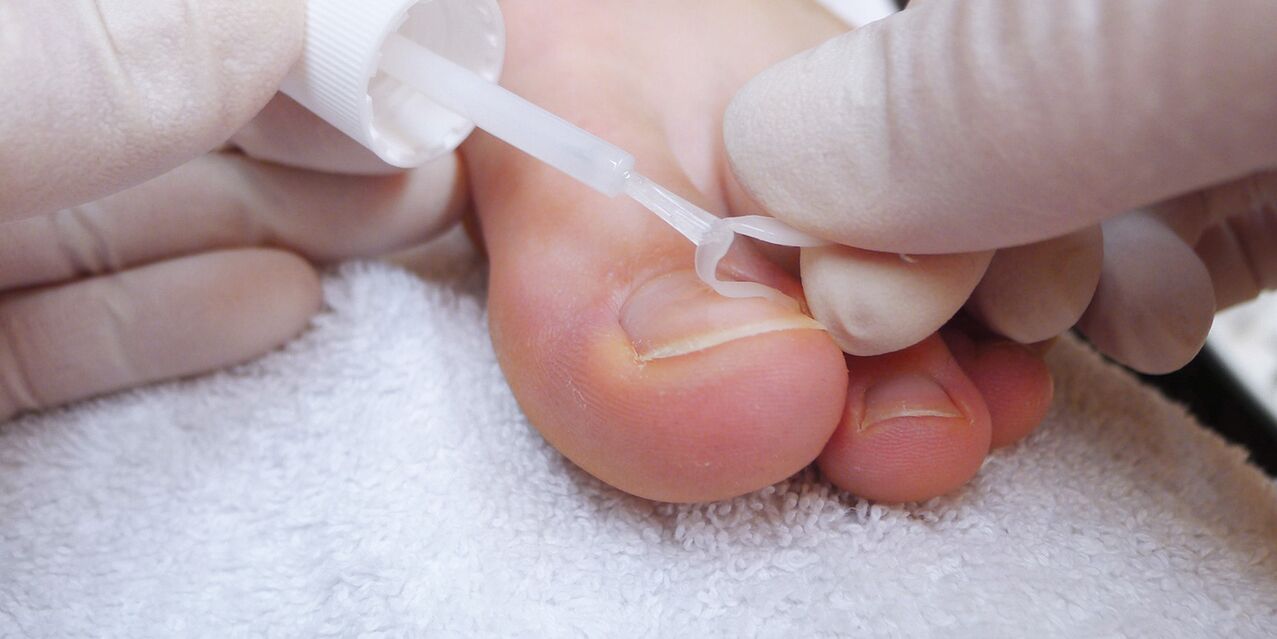 medizinischer Lack gegen Nagelpilz