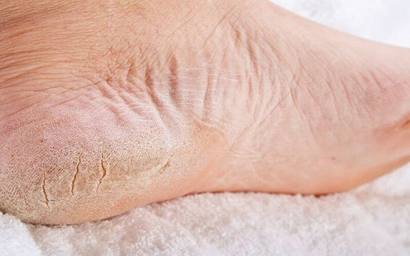Symptome von Fußpilz