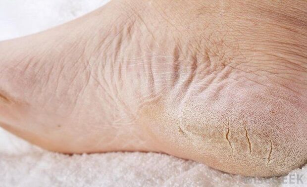 Trockene Füße sind ein Zeichen für Pilzbefall. 
