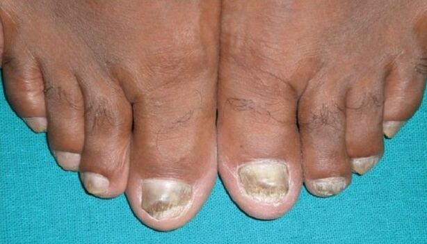 Nagelpilz