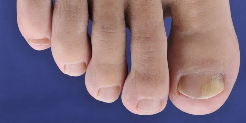 Symptome von Hautmykose und Nagelplatten