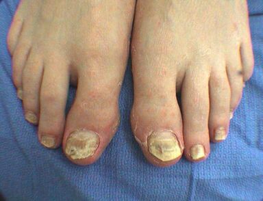 Nagelpilzsymptome