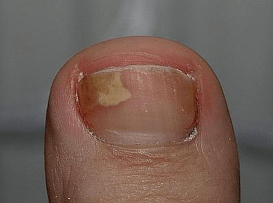Pilz auf der linken Seite des Nagels