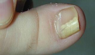 Anzeichen und Symptome von Nagelpilz