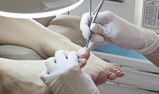 Chirurgische Eliminierung des Nagels in Gegenwart eines Pilzes