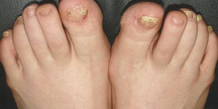 Was ist Nagelpilz